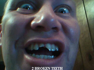 2 BROKEN TEETH